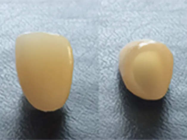 オールセラミック・クラウン