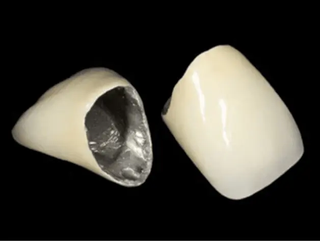 メタル・ボンド