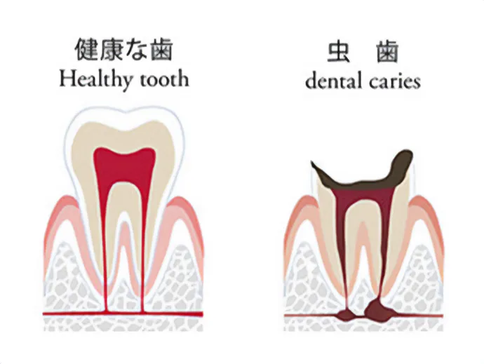 健康な歯と虫歯