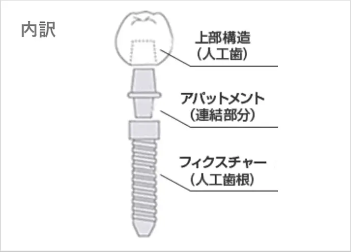 インプラント内訳　上部構造・アパットメント・フィクスチャー