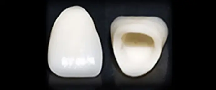 オールセラミック