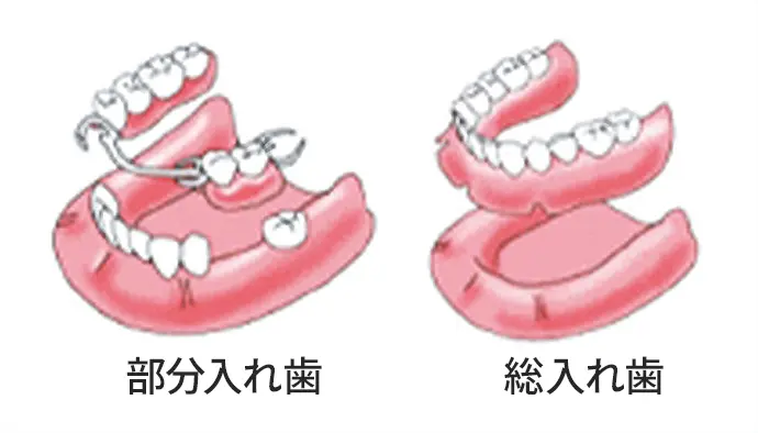 部分入れ歯と総入れ歯 図解