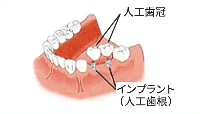 インプラント 図解