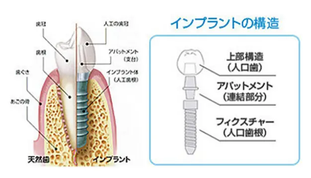 インプラントの構造 図解