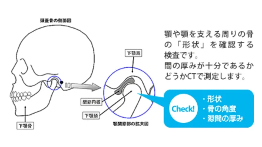 顎関節CT検査