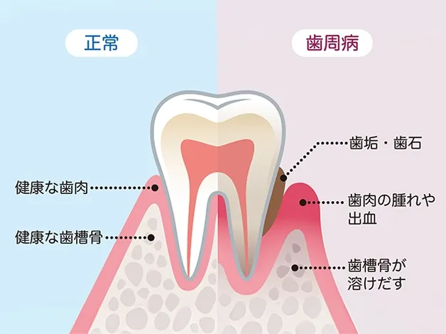 歯肉炎から歯周炎への進行プロセス
