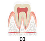 虫歯の初期段階 C0