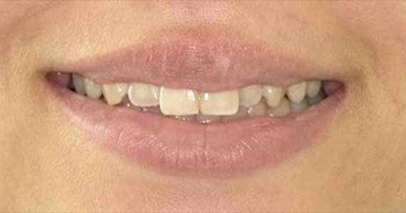 オールセラミッククラウンで綺麗な前歯 症例写真01