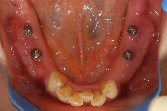 治療途中：下あごに4本インプラントを埋入