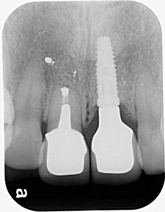 前歯のインプラントで審美＆機能どちらもUP 症例写真02