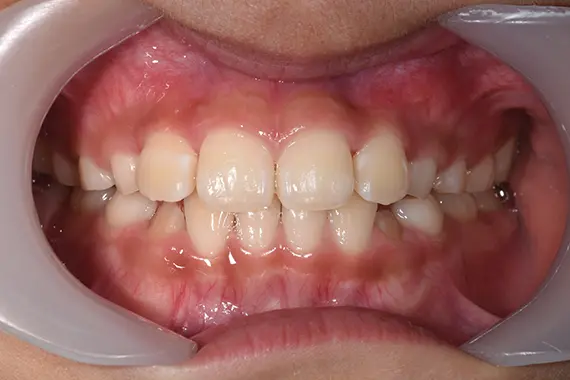 「受け口（反対咬合）を早期対処しましょう！」 AFTER画像