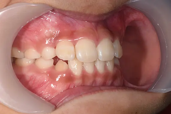 矯正後：横から