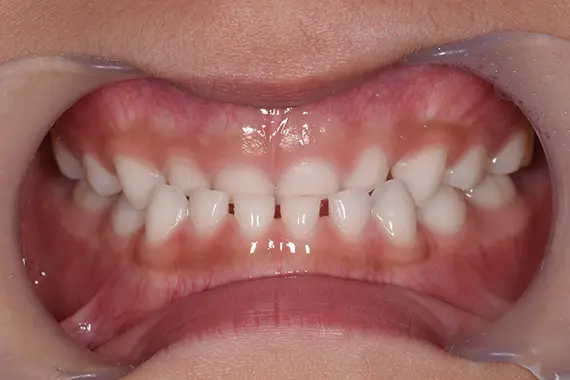 「受け口（反対咬合）を早期対処しましょう！」 BEFORE画像