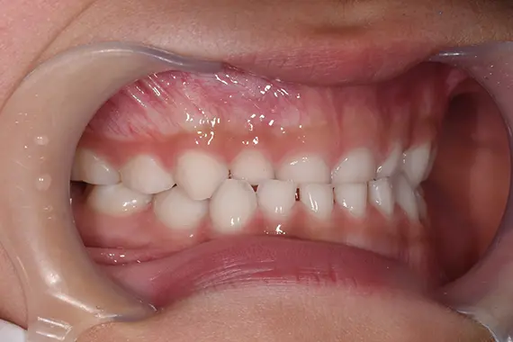 矯正前：横から