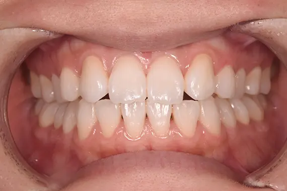 「歯の色で口元の印象が変わります！」 AFTER画像