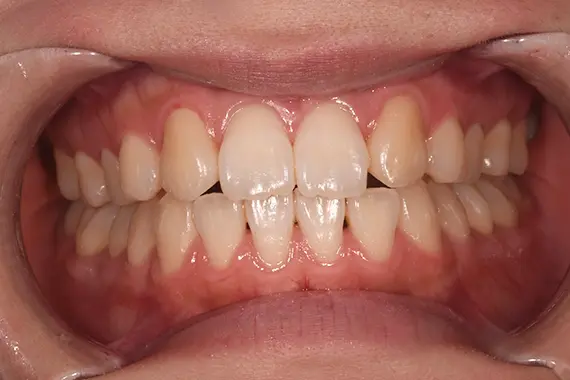 「歯の色で口元の印象が変わります！」 BEFORE画像